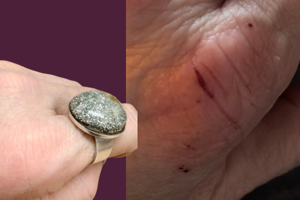 Informatives Foto: links im Bild sieht man einen Zeigefingerknöchel auf dem alles verheilt ist. Ein großer runder Silberner Ring mit einer silbrigen kuppelförmigen Füllung ist am Ringfinger.
Der Hintergrund des Fingers ist Bordeaux.  Auf dem rechten Foto ist der Zeigefingerknöchel zu sehen, auf dem ein Quereinschnitt von ca. 1 cm zu sehen ist und er ist blutig. Der Knöchel ist rot.
 